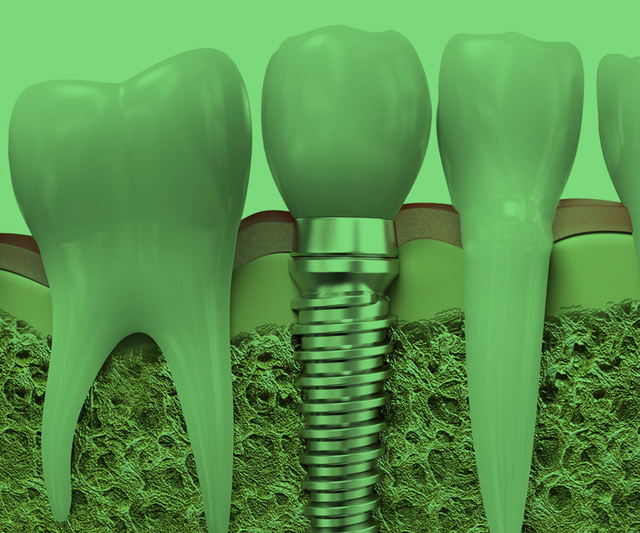 Dental Implants